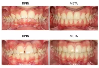 ORTHODONTIC SMILES CLINIC - ΤΣΟΥΡΑΚΗΣ Α. - ΠΑΠΑΜΑΝΟΥ Δ. Ορθοδοντικοί Βέροια